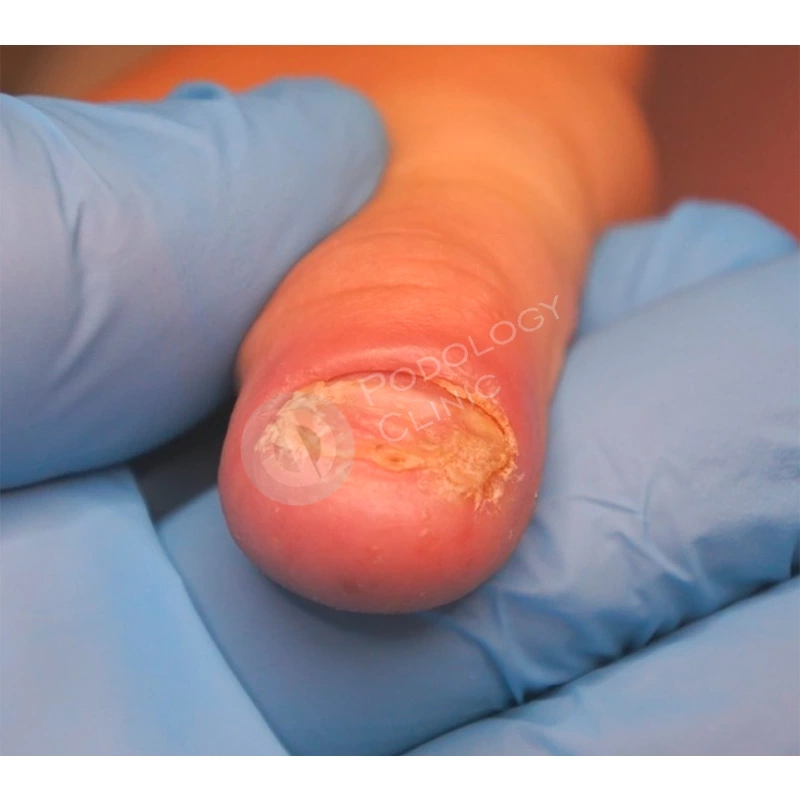 Где можно диагностировать и вылечить грибок на пальцах ног у ребенка в Киеве