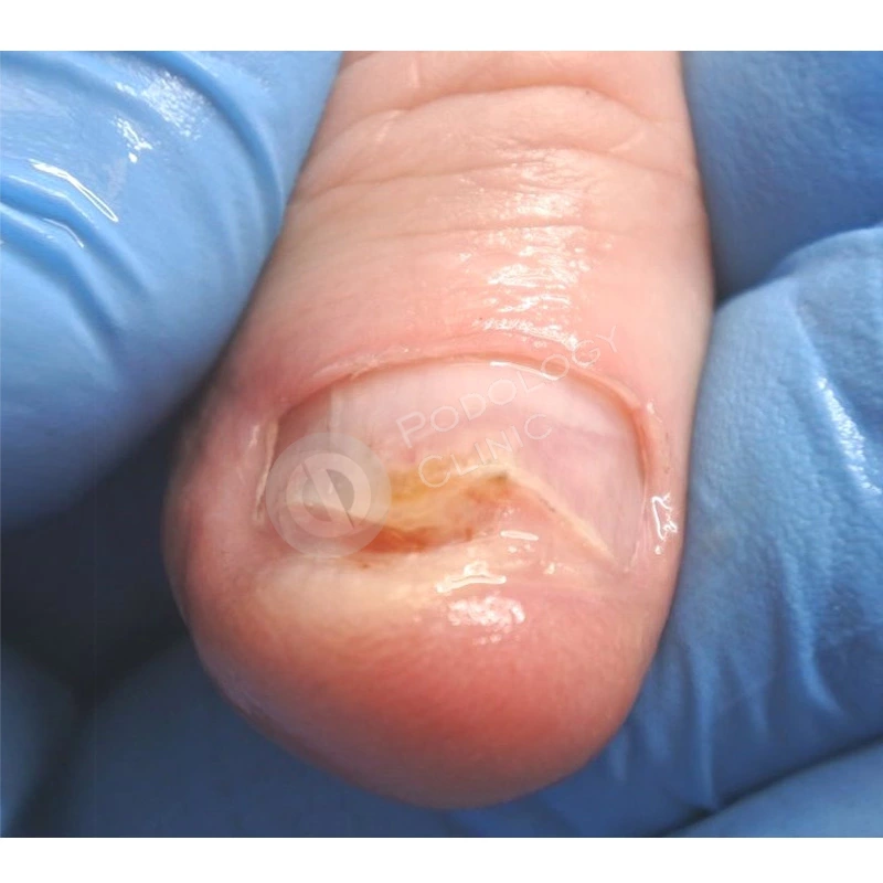 Рак ногтей: симптомы, диагностика и лечение