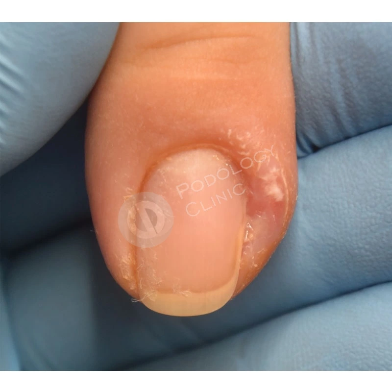 Гной и боль в пальце возле ногтя. Как лечить нарыв около ногтя?
