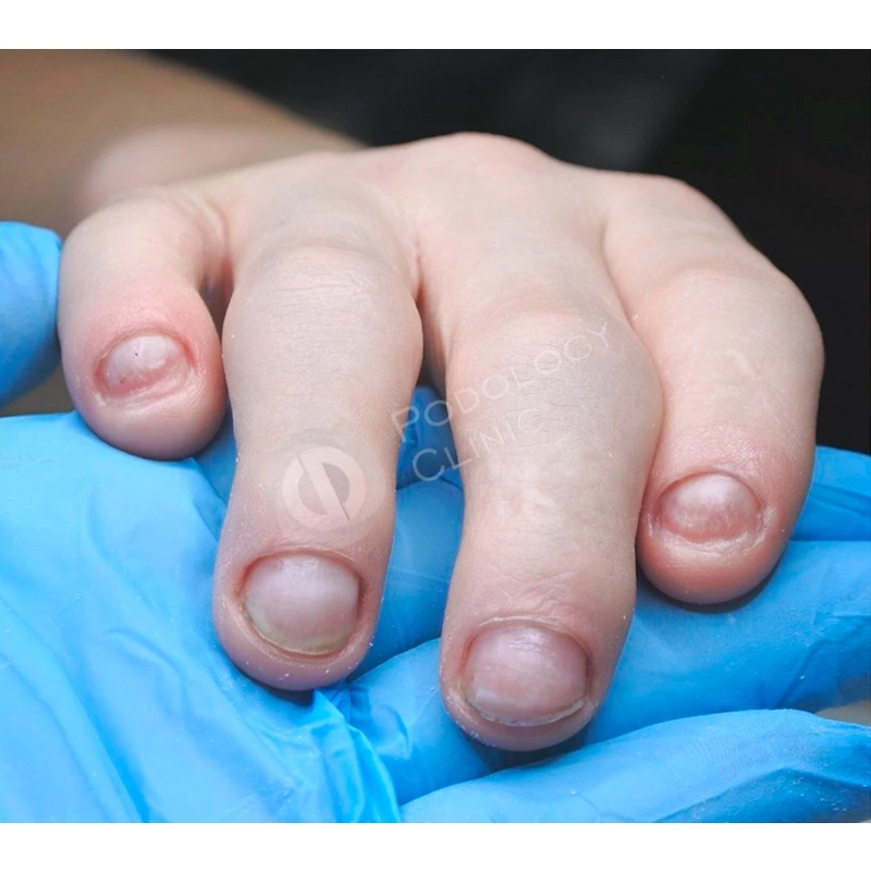 Заболевания ногтей (Грибковые, вирусные и др)