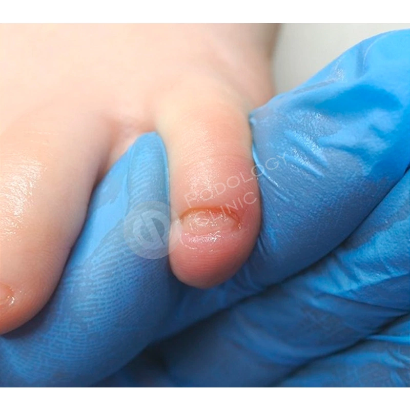 Лечение вросшего ногтя у младенцев