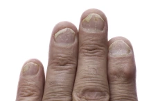 Трескается кожа на пальцах: причины и что делать | Бархатные ручки