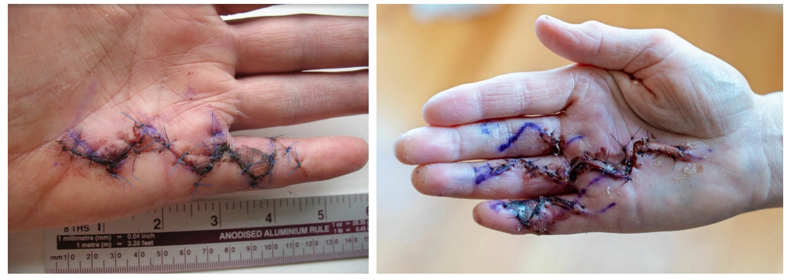Рука после операции