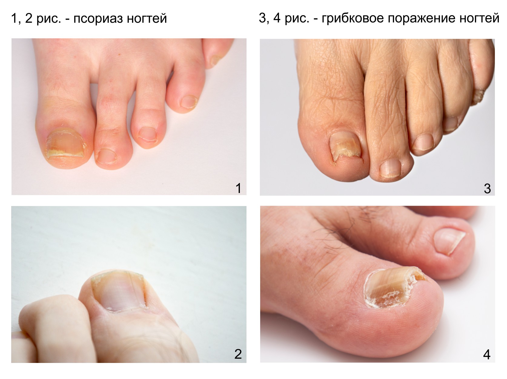 Клинические различия псориаза ногтей и грибка ногтей