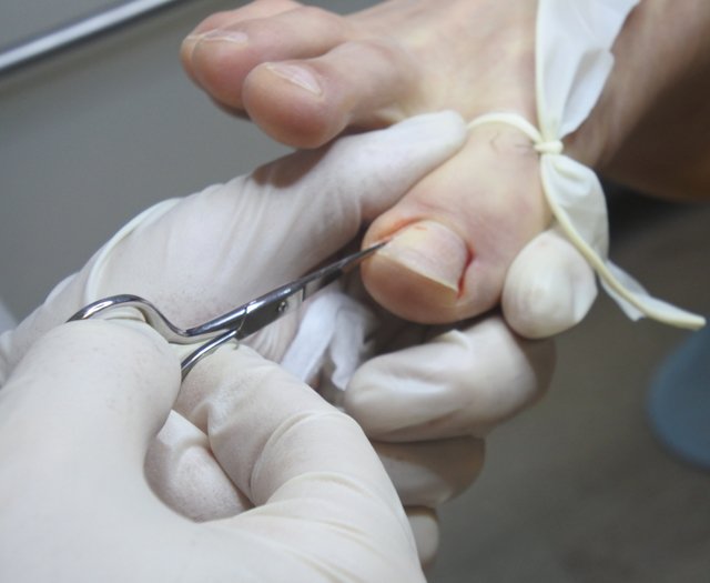Краевая резекция вросшего ногтя в клинике Подологии