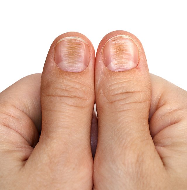 Изменение ногтей на больших пальцах рук