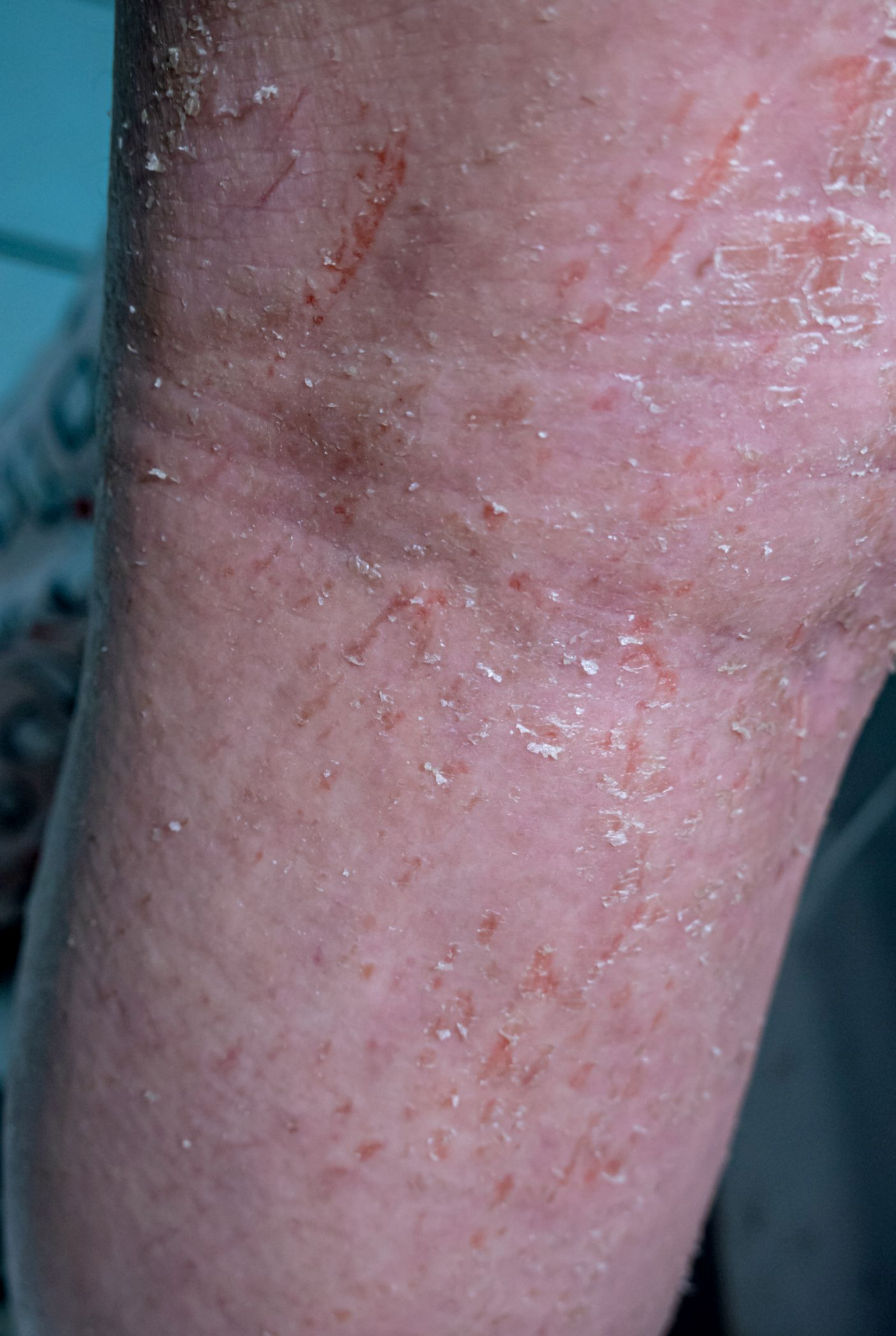 Атопический дерматит на ноге.jpg