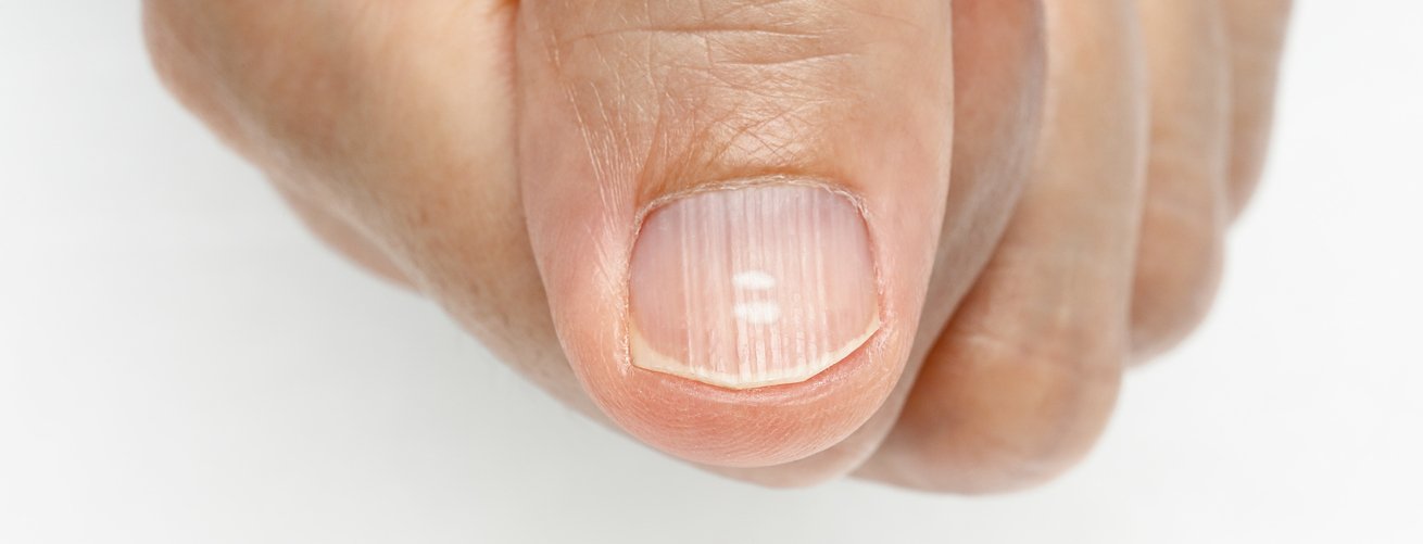 Ониходистрофия ногтевой пластины