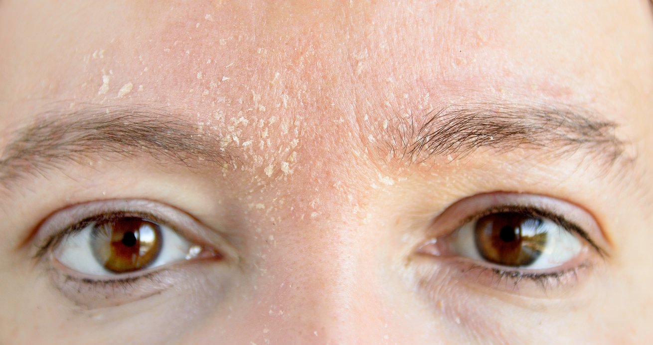 Шелушится кожа на голове – симптомы, причины, лечение