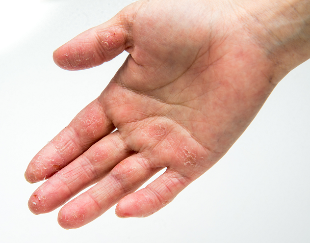 Трескается кожа на пальцах рук, причины, лечение, 6 рецептов масок для рук