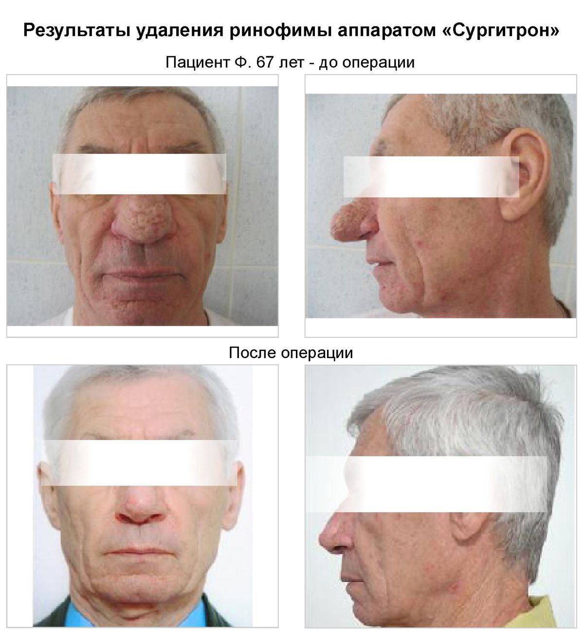 Лечение ринофимы носа в Клинике Подологии, фото до и после