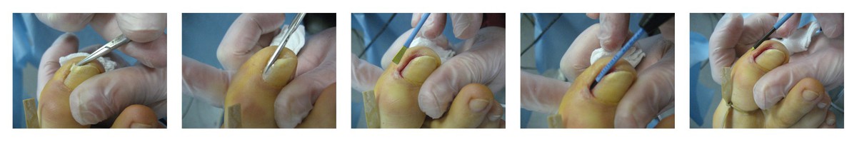 Применение радиоволнового лечения вросшего ногтя