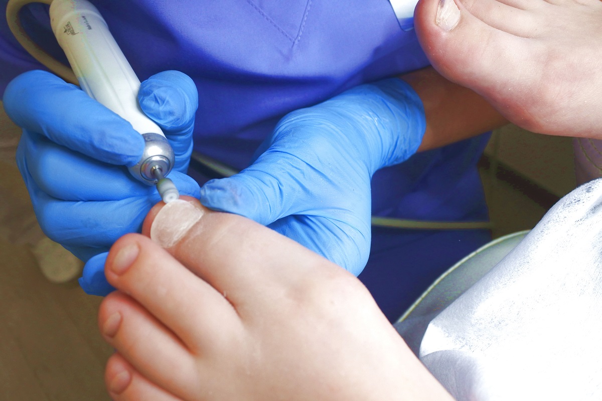 Протезирование ногтя на ноге
