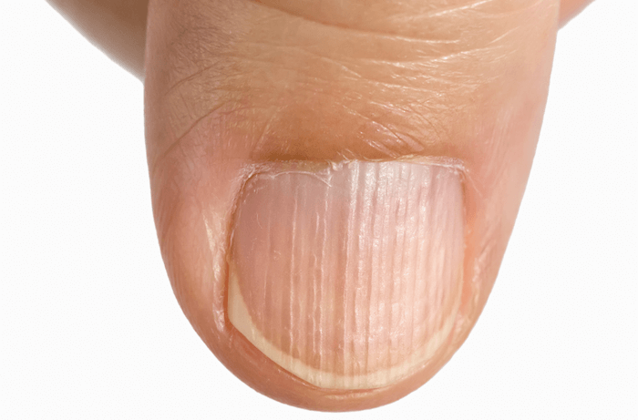 Как вылечить грибок ногтей и сколько это стоит