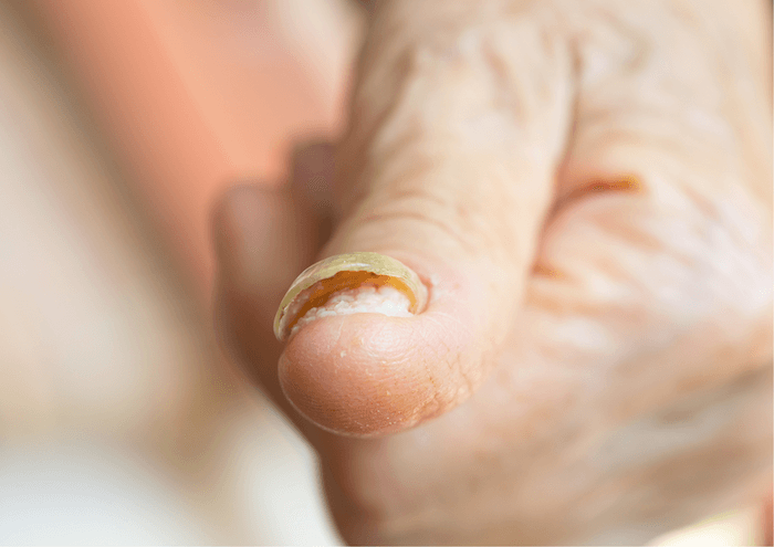 Как лечить грибок на пальцах ног