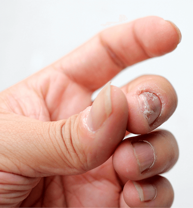 Симптомы артрита пальцев рук