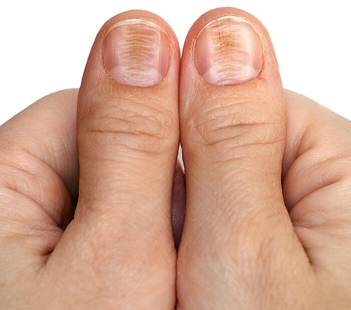 О каких диагнозах расскажут ногти ребенка?