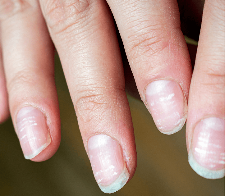 Полоски белого цвета на ногтях рук
