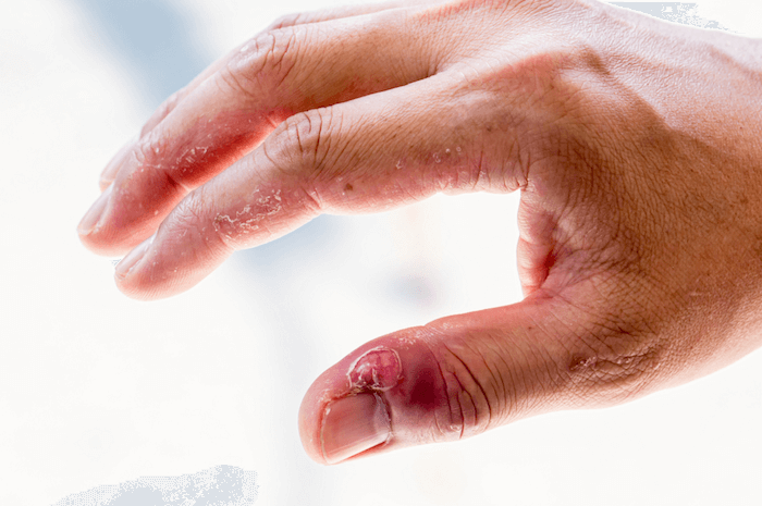 Воспаление около ногтя на руке