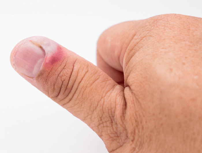 Воспаление у ногтя на большом пальце руки