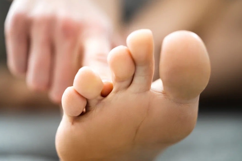 Трещины между пальцев ног