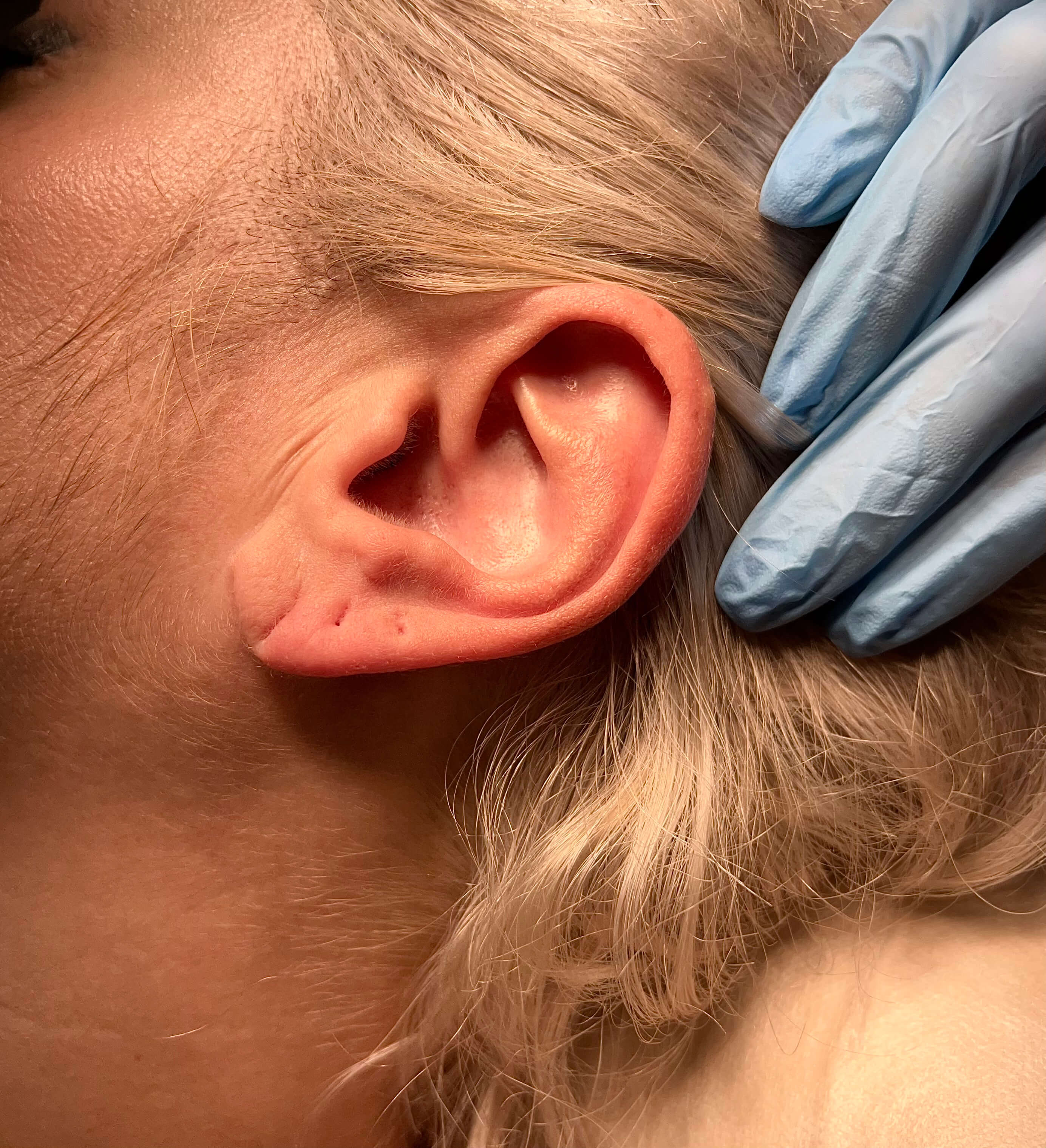 Как зашить мочку уха