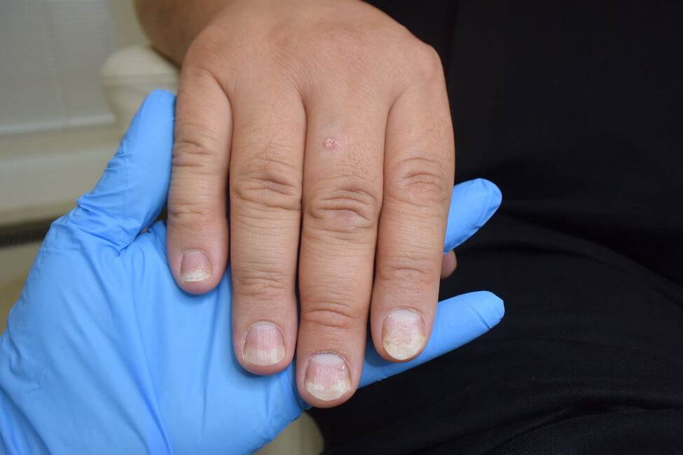 Лечение псориаза ногтей