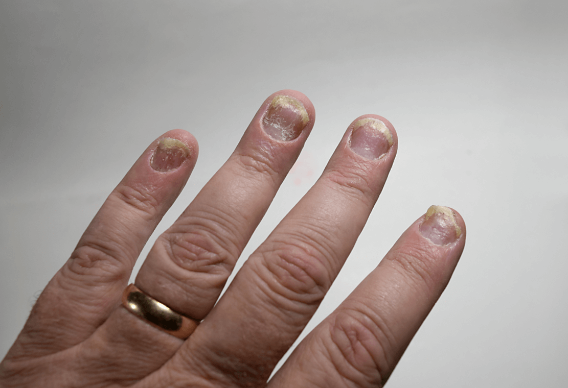 Причины псориаза ногтей