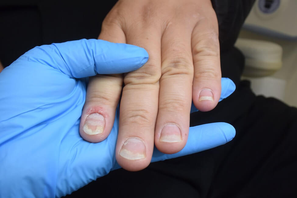 Симптомы псориаза ногтей