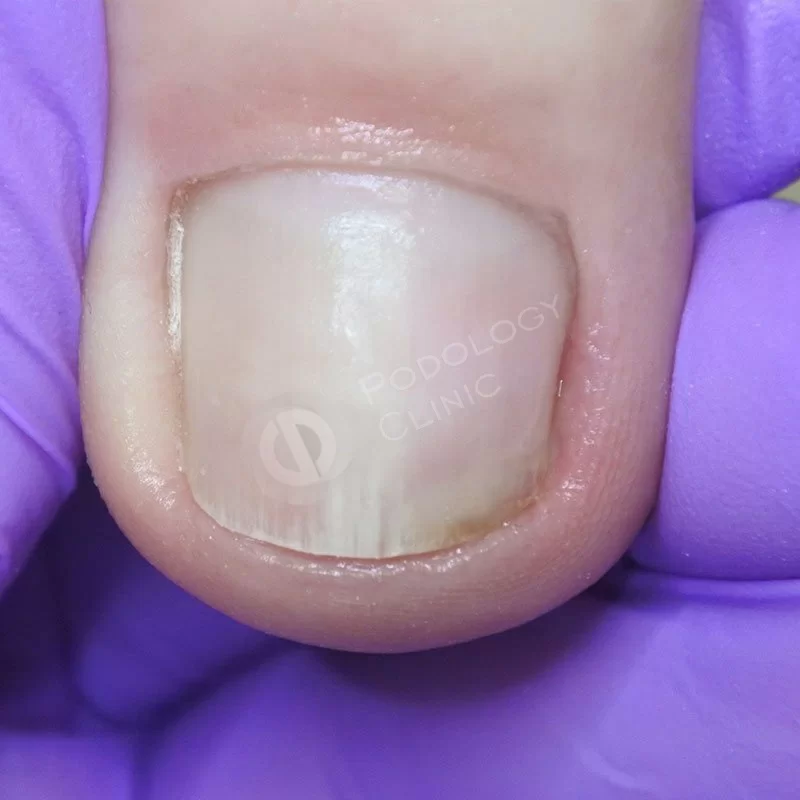 Грибок ногтей на ногах лечение в центрах