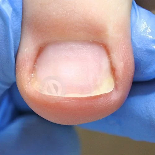 Вросший ноготь на большом пальце ноги лечение цена