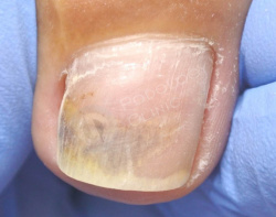 Удаление лазером ногтя при сахарном диабете thumbnail