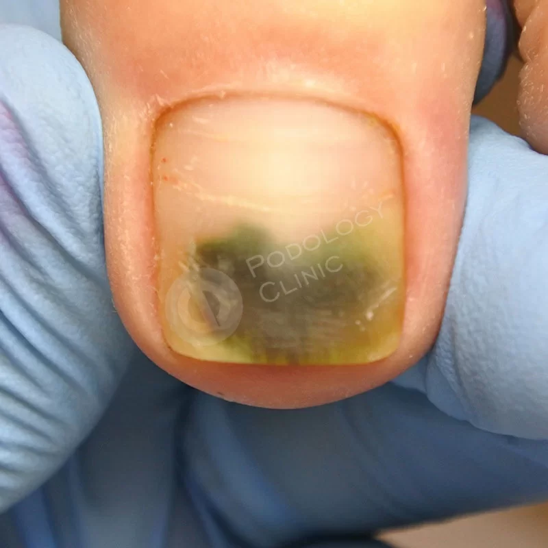 Лечение ногтевого грибка на ногах клиники