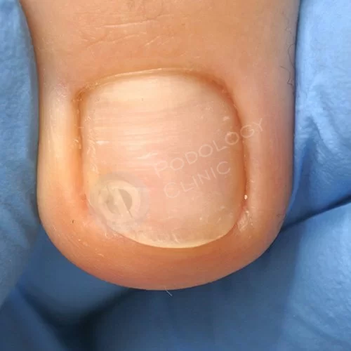Лечение поврежденного ногтя на ноге