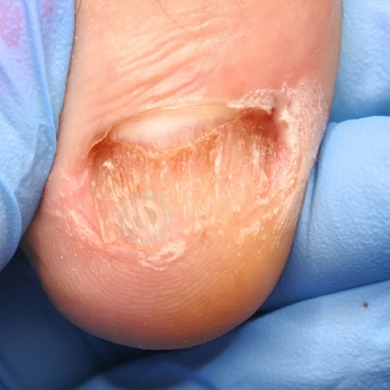Лечение грибка ногтей ног в москве