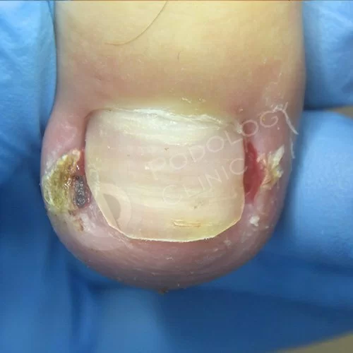 Лечение вросшего ногтя на ноге в москве