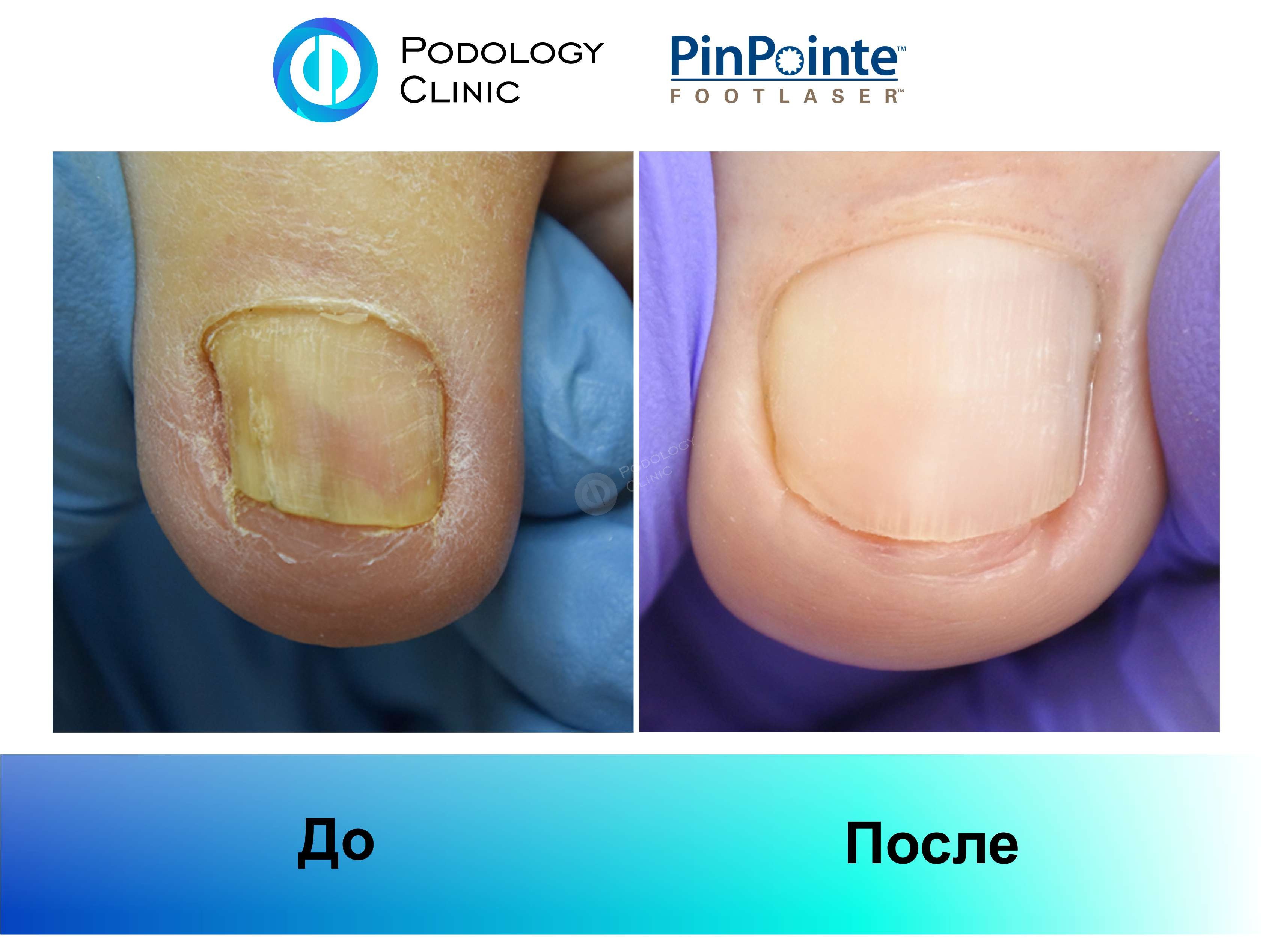 Примеры работы лазера PinPointe FootLaser в лечении онихомикоза, фото 2