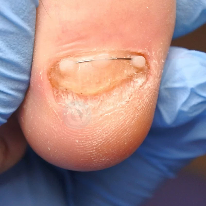 Грибок на ногте большого пальца ноги лечение цена thumbnail