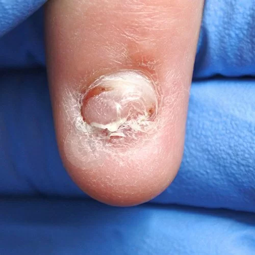 Лечение при травме ногтя на ноге thumbnail