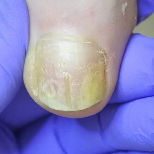 Лечение ногтевого грибка на ногах клиники
