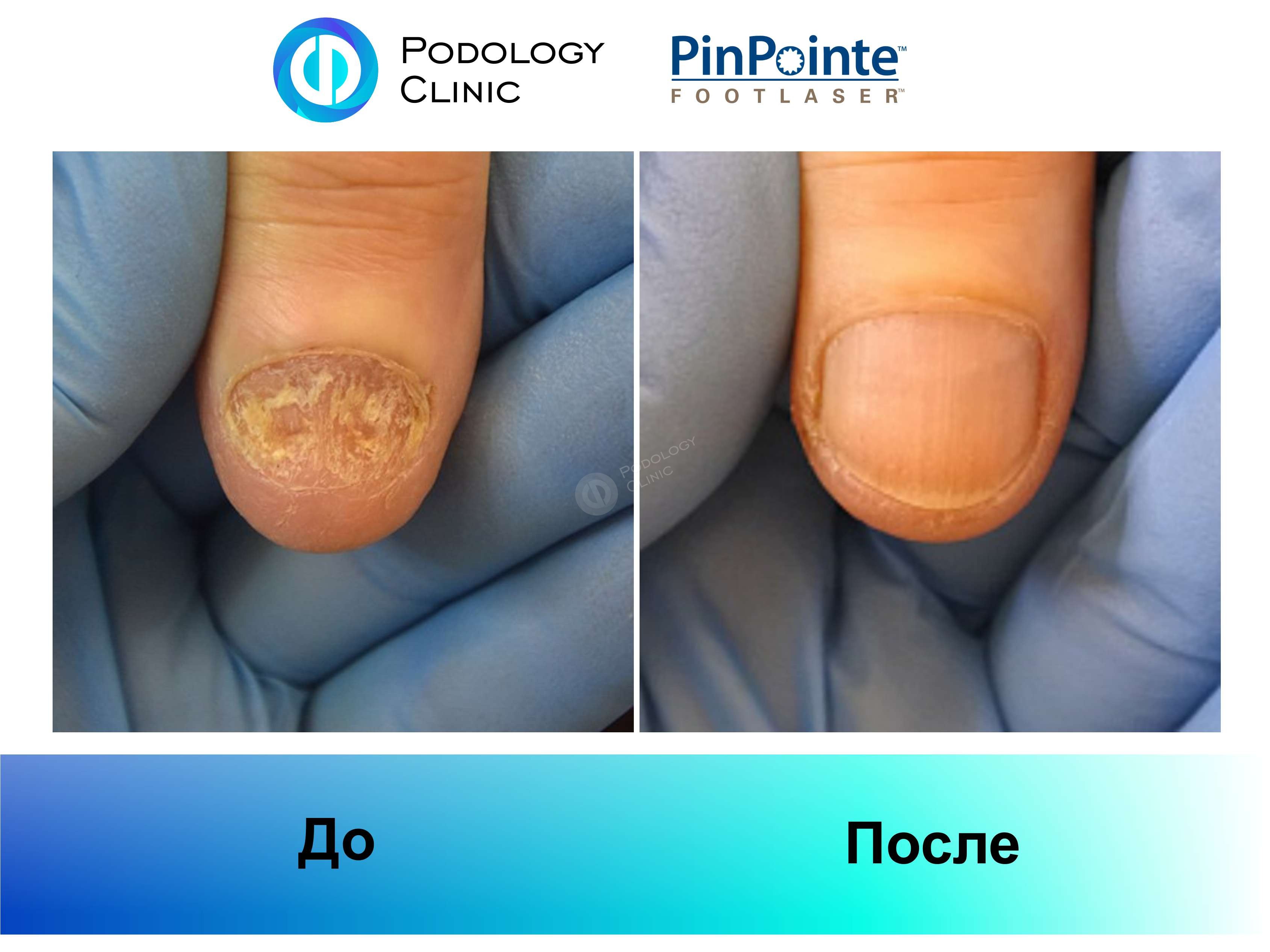 Примеры работы лазера PinPointe FootLaser в лечении онихомикоза, фото 6