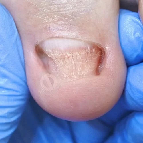 Клиники лечение грибка ногтей ног