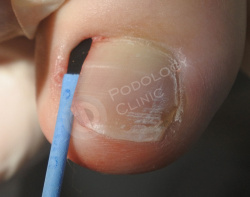 Удаление лазером ногтя при сахарном диабете