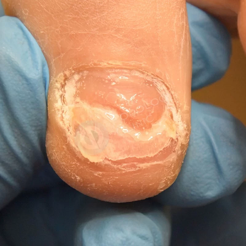 Лечение поврежденного ногтя на ноге