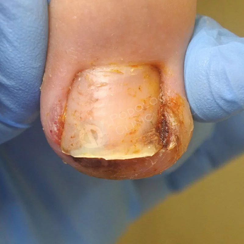 Лечение вросшего ногтя на ноге в москве