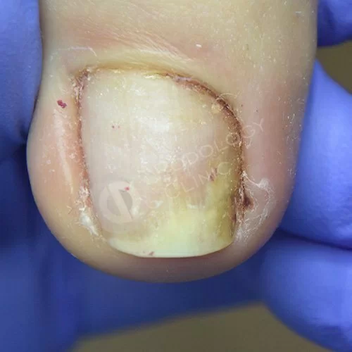 Вросший ноготь на большом пальце ноги клиника лечение