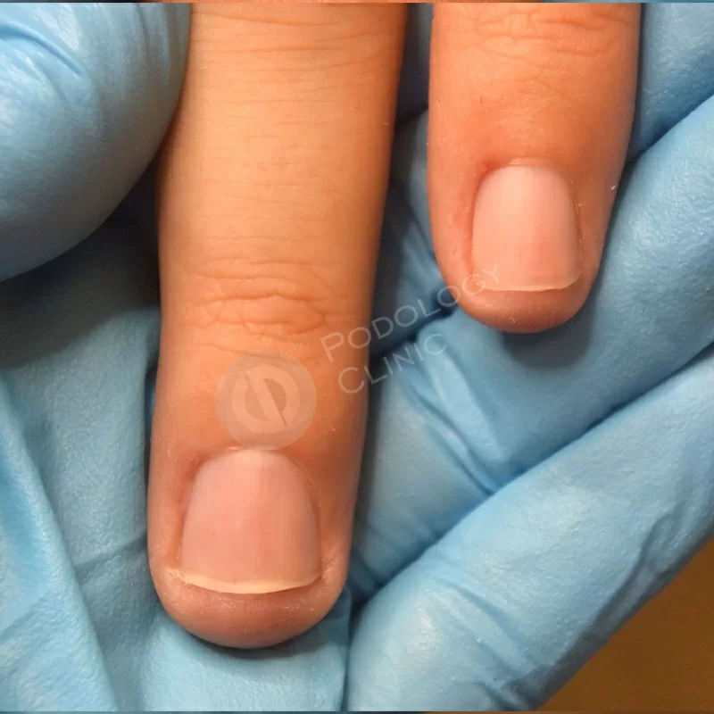 Методы удаления бородавок на руках в клинике