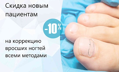 Скидка 10% на коррекцию вросших ногтей