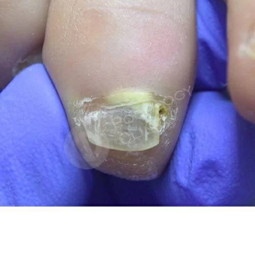 Травма ногтевой пластины на ноге лечение thumbnail