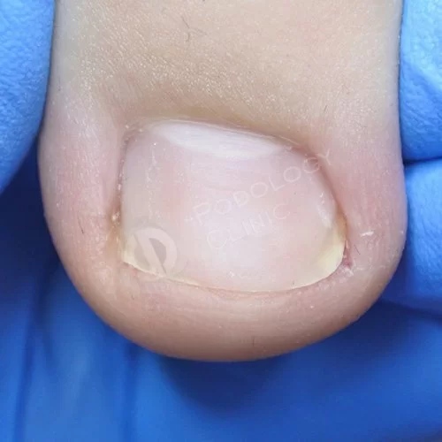 Лечение вросшего ногтя на ноге в москве thumbnail